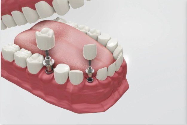 Ilustração de implantes dentários fixados no osso